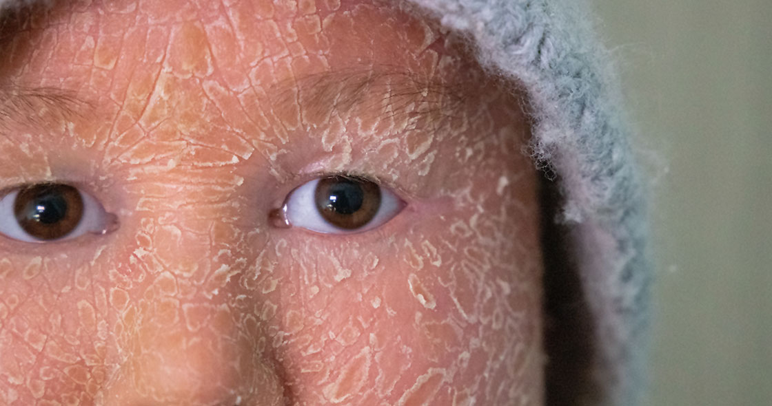 Cinfa La Mirada del Paciente: Visibilidad Enfermedad Discapacidad